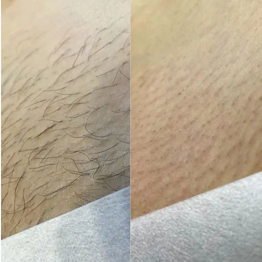 Resultados Piel Suave