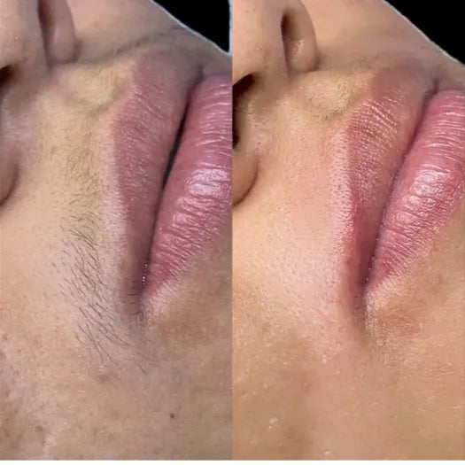 Resultados Vello Facial